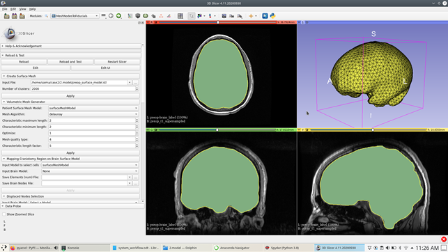 Surface triangulation of patient-specific brain model (seeFig. 1.4{reference-type="ref"reference="fig:surface_model"}) with 2000clusters.
