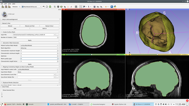 Surface triangulation of patient-specific brain with 5000clusters.