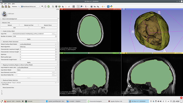 A clipped, uniformly triangulated patient-specific brain surfacemodel.