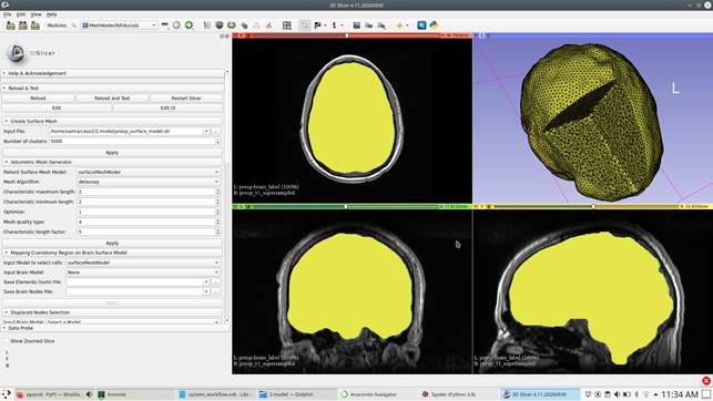 Patient-specific brain model filled with tetrahedralelements.