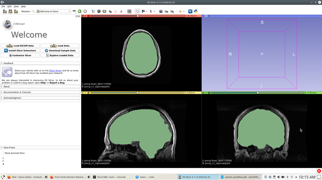 Results of skull stripping using FreeSurfer loaded into 3DSlicer.