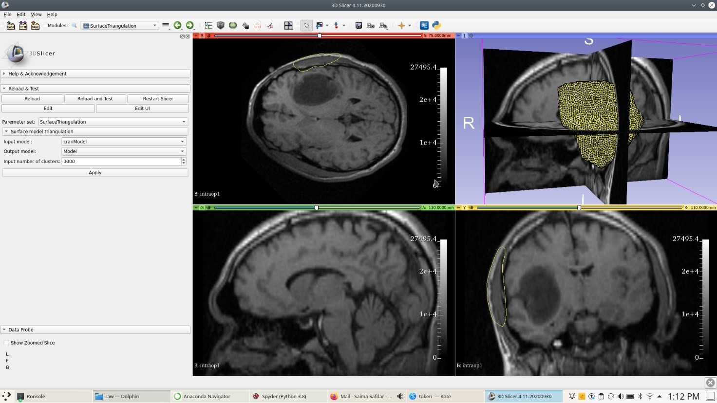 Patient-specific craniotomy region modeltriangulation.