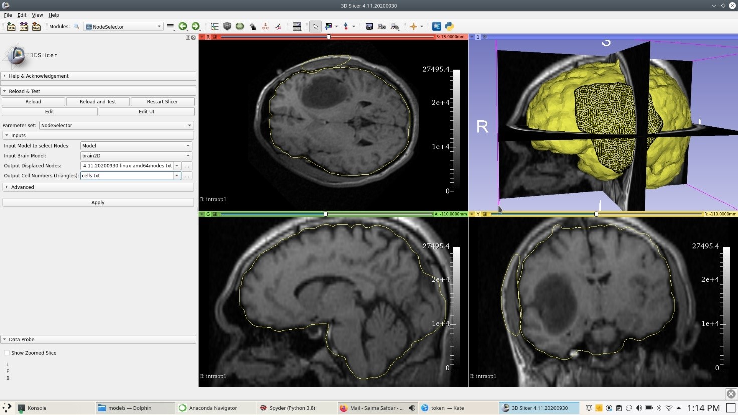 NodeSelector module within 3D Slicer along with patient-specific brainmodel and craniotomy reference geometry for selecting nodes undercraniotomy on brain surface.