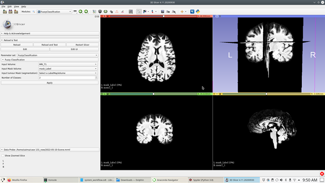 Fuzzy classification module along with classification results within3D Slicer.