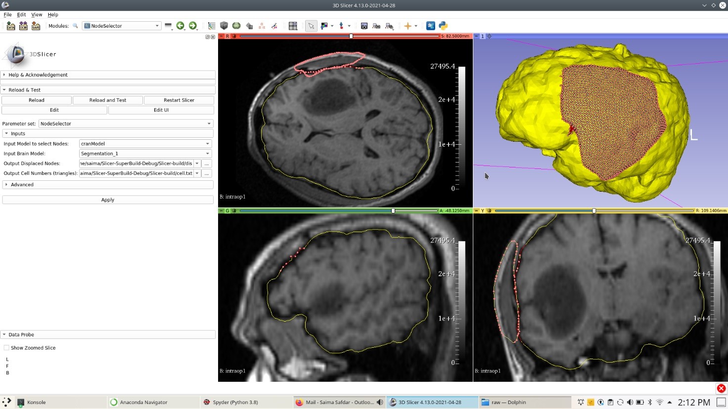 Patient-specific brain model with selected loaded nodes undercraniotomy.