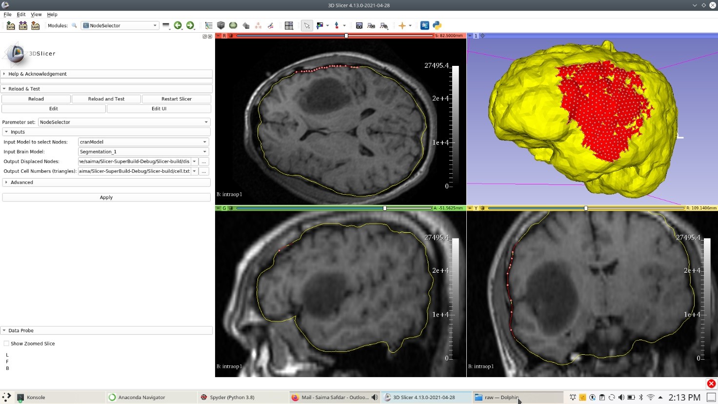 Patient-specific brain model with selected nodes under craniotomy(highlighted red region) in 3D window along with showing nodes (reddots) in axial, sagittal and coronal view. Yellow outline around brainin axial, sagittal and coronal view shows the boundary of the resulting3D patient-specific braingeometry.