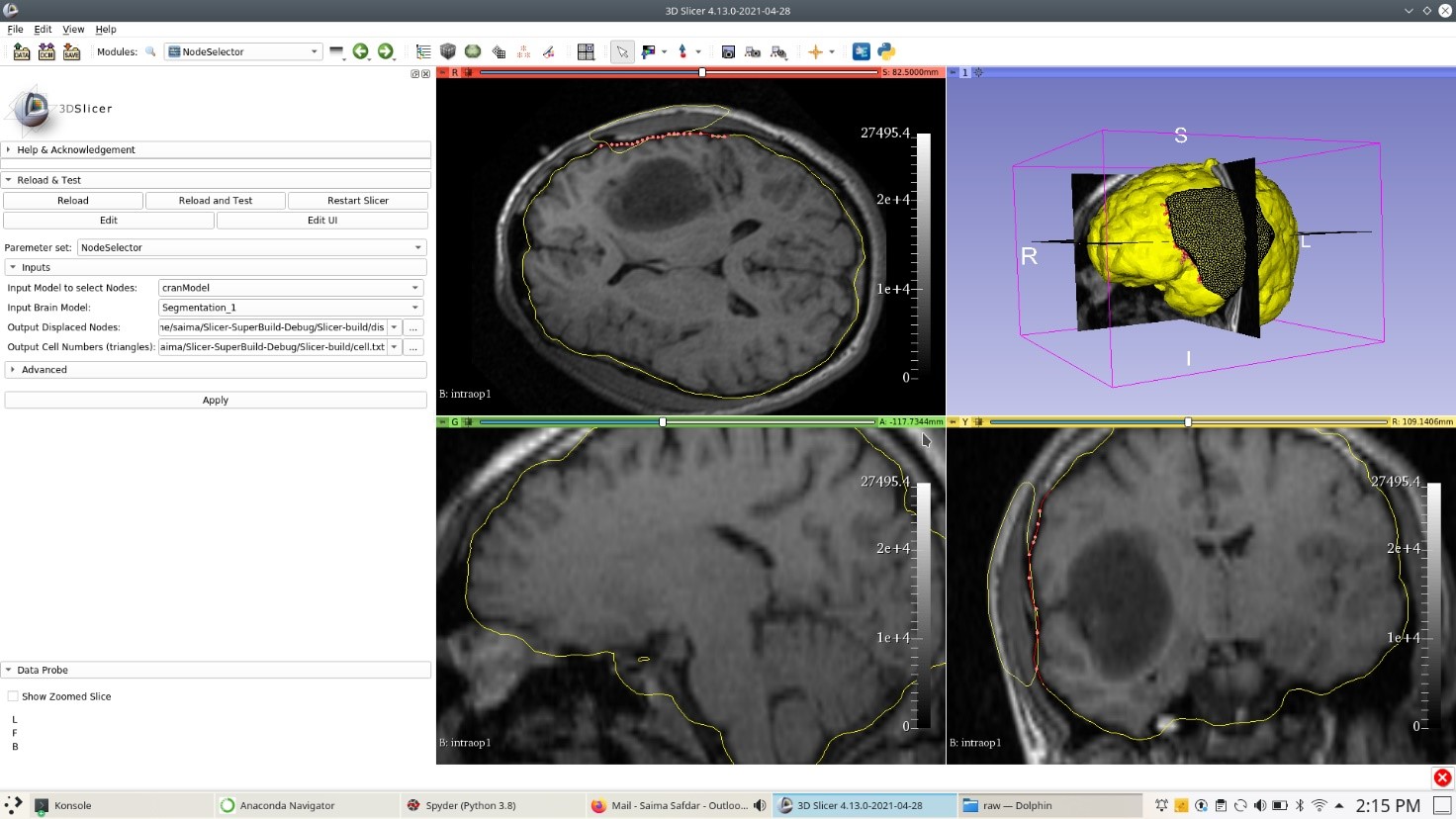 NodeSelector module outcome along with 3D brain model and 3Dcraniotomy model in 3D window within 3D Slicer.