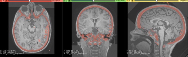 Rigid registration results of pre-operative MRI to intra-operative CTwithin 3D Slicer.