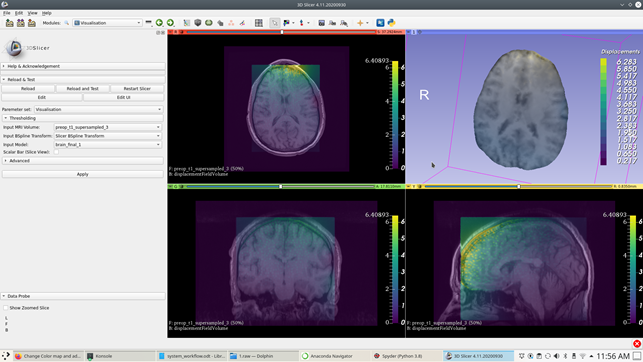 Visualisation module within 3D Slicer along with visualisation ofcraniotomy induced brain shift results.