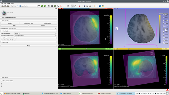 Visualisation module within 3D Slicer along with visualisation ofelectrode placement-induced brain shiftresults.