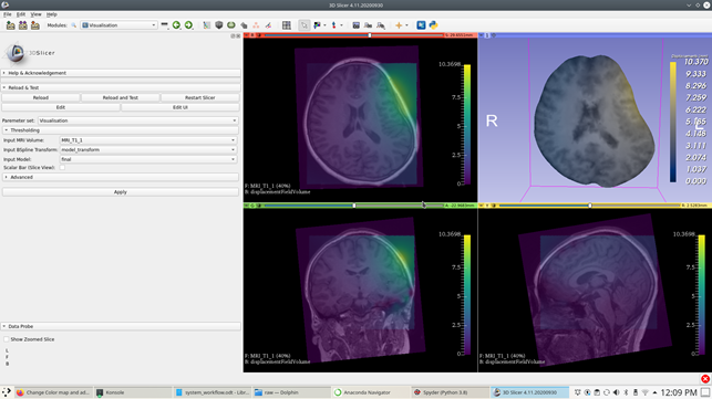 Visualisation module within 3D Slicer along with visualisation ofelectrode placement-induced brain shift results with overlaying CT imagein foreground.