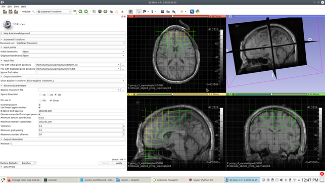 Scattered transform module along with transformed pre-operative MRI inaxial, saggital and coronal view.